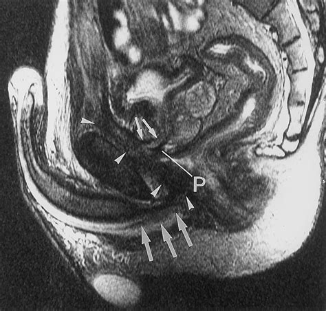 x ray sex|Magnetic resonance imaging of male and female genitals during .